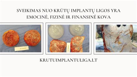 Krūtų implantų įdėjimo vietos