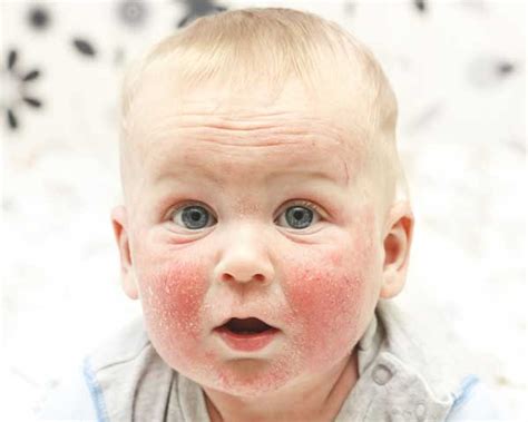 Vaikas su atopiniu dermatitu ir herpine egzema