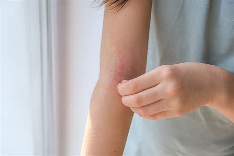 Simptomai kontaktinio dermatito ant rankų
