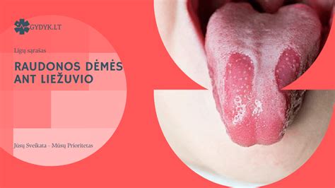 Kūdikių burnos pienligės nuotrauka: baltos apnašos ant liežuvio ir skruostų