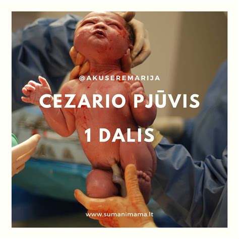 Cezario pjūvio operacija: statistika ir indikacijos