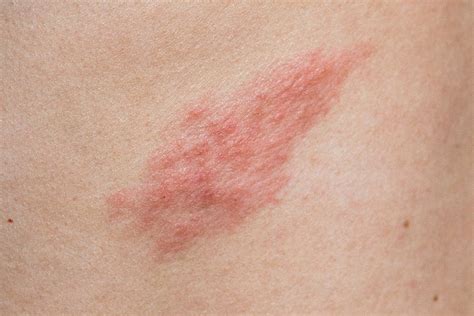 Polimorfinis nėščiųjų bėrimas ant pilvo