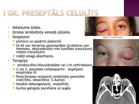 Schema, iliustruojanti galimas ausų uždegimo komplikacijas.