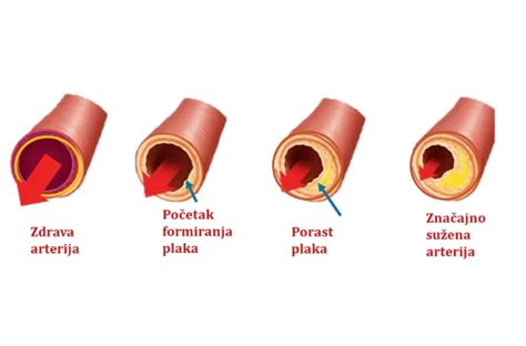 Aterosklerozės pažeista arterija