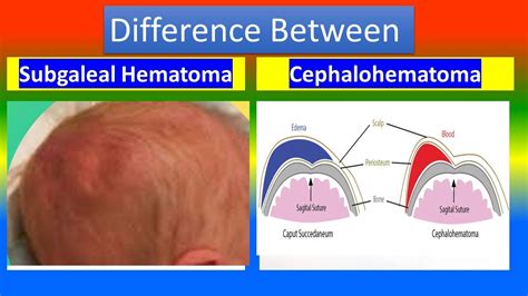 Naujagimio galvos hematoma