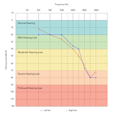 audiogram chart showing hearing loss