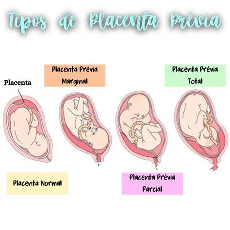 Placentos užgimimas