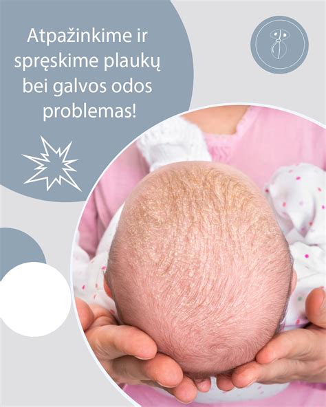 kūdikio plaukų augimas