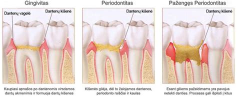 periodontito pažeistos dantenos ir kaulas