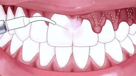 Paveikslėlis, iliustruojantis dantenų uždegimo (gingivito) simptomus