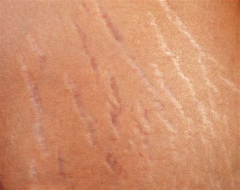 Nėštumo metu atsirandančios strijos ir jų prevencija