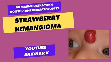 vaiko hemangioma