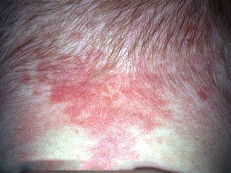 Naujagimio odos požymiai: Milia ir Gandro žnybis