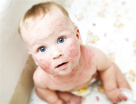 Atopinio dermatito simptomai vaikams
