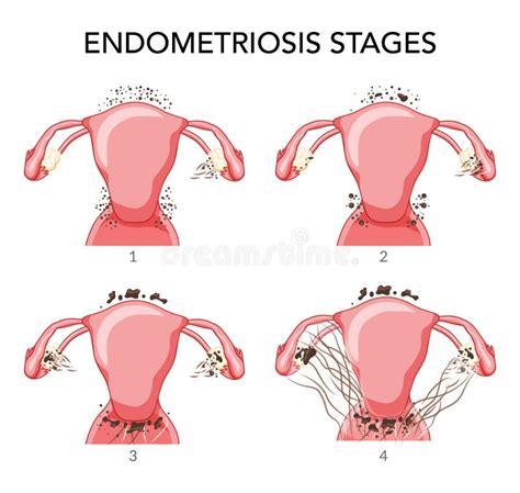 Simptomų schematinis pavaizdavimas sergant endometrioze