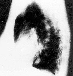 Plaučių rentgenograma su matomais uždegiminiais pakitimais