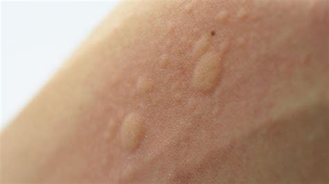 Dilgėlinė nėščiųjų dermatozė (PUPPP) ant pilvo