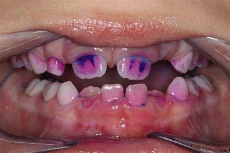 Apnašą dažančios tabletės