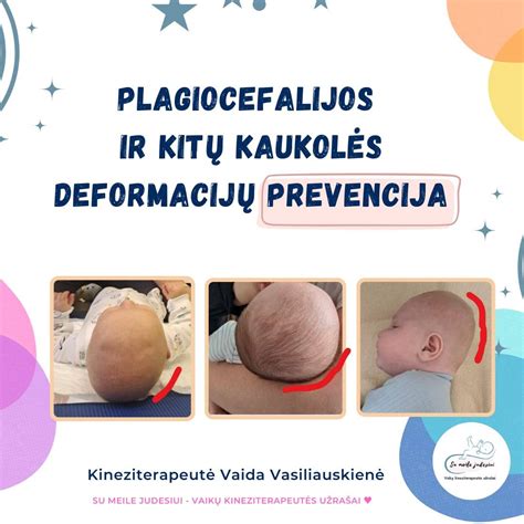 Kūdikio galvos asimetrija ir kreivakaklystė