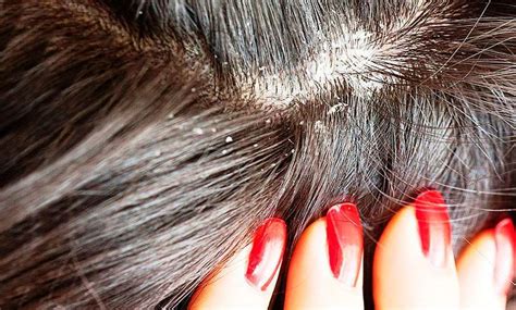 Schema, kaip atsiranda pleiskanos