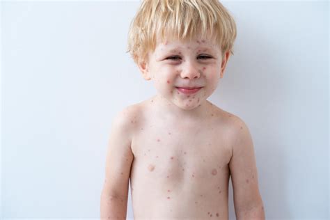 Vaiko odos infekcijų pavyzdžiai