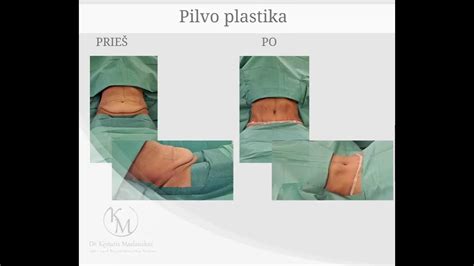 Vizualizacija pilvo plastikos operacijos