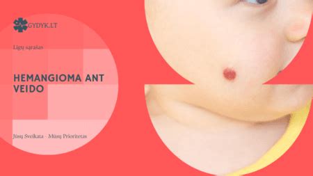 hemangioma ant kūdikio odos
