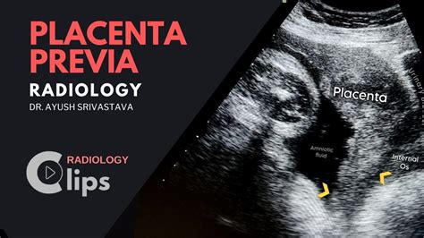 scheminis placentos previa ir placentos atsiskyrimo pavaizdavimas