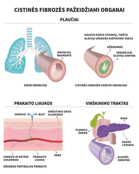 Naujagimių patikros dėl cistinės fibrozės schema