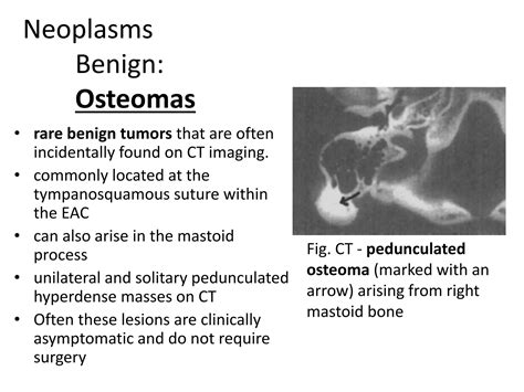 Osteoidinės osteomos rentgenograma