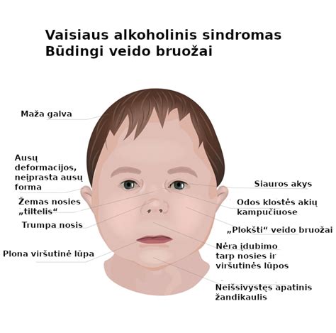 vaiko su vaisiaus alkoholiniu sindromu veido bruožai