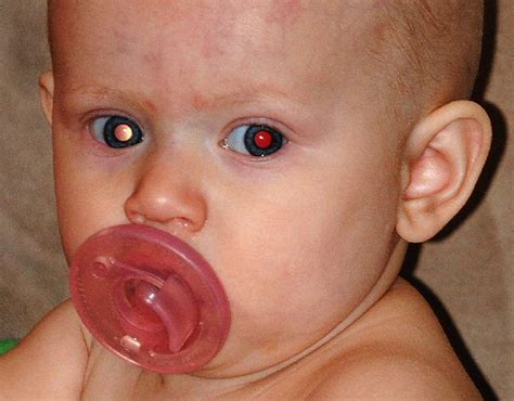 baby with red eye
