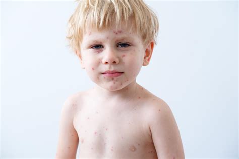 Vaiko oda su bėrimu