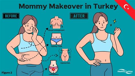 Mommy Makeover operacijos samprata