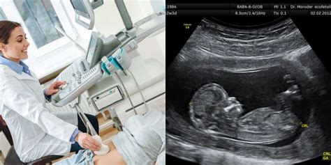 Schema apie vaisiaus matmenų matavimą echoskopijos metu