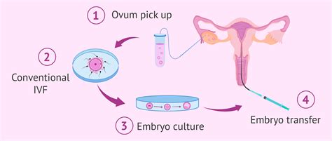 schema, iliustruojanti apvaisinimo mėgintuvėlyje (IVF) procesą