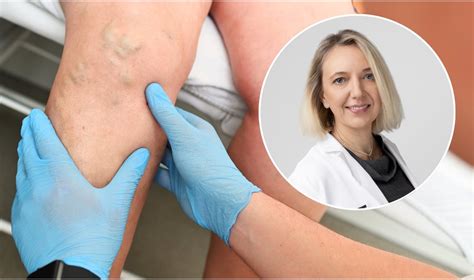 Nėščios moters kojų anatomija ir venų varikozė