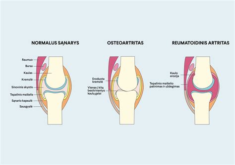 Simptomų palyginimas: Artritas vs Bursitas