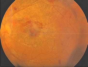 palyginimas: sveikas ir pažeistas akių dugnas