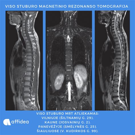 Stuburo išvaržos diagnostika (MRT)