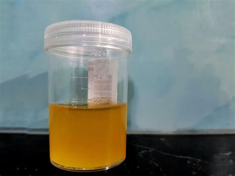 infografika: kaip surinkti šlapimą tyrimams