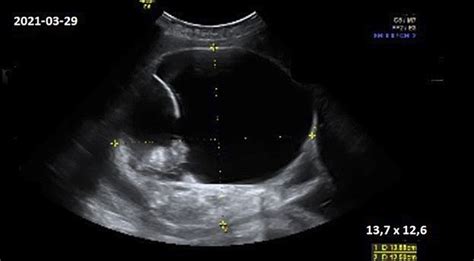 ultragarsinis nėštumo tyrimas 6-ą savaitę