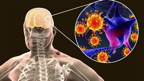 Erkinis encefalitas: simptomai ir prevencija