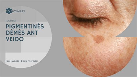 pigmentinės dėmės nėštumo metu