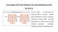 Cezario pjūvio operacija