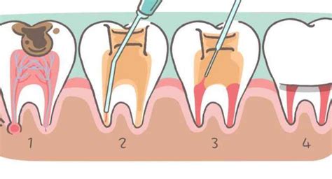 Paveikslėlis, vaizduojantis danties karieso progresavimą