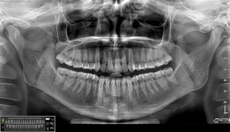 Rentgeno nuotrauka, vaizduojanti danties šaknų kanalų gydymą