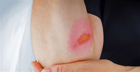 Pragulos ir jų profilaktika