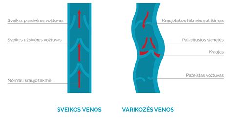 Schema: Kaip veikia venų varikozė ir jos gydymas lazeriu