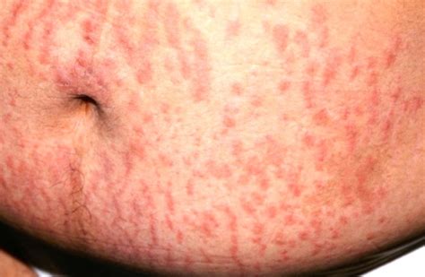 Simptomai, būdingi dilgėlinei nėščiųjų dermatozei (PUPPP)
